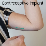 Contraceptive Implant: Link to Information