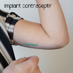 Implant contraceptif (IMPLANT)