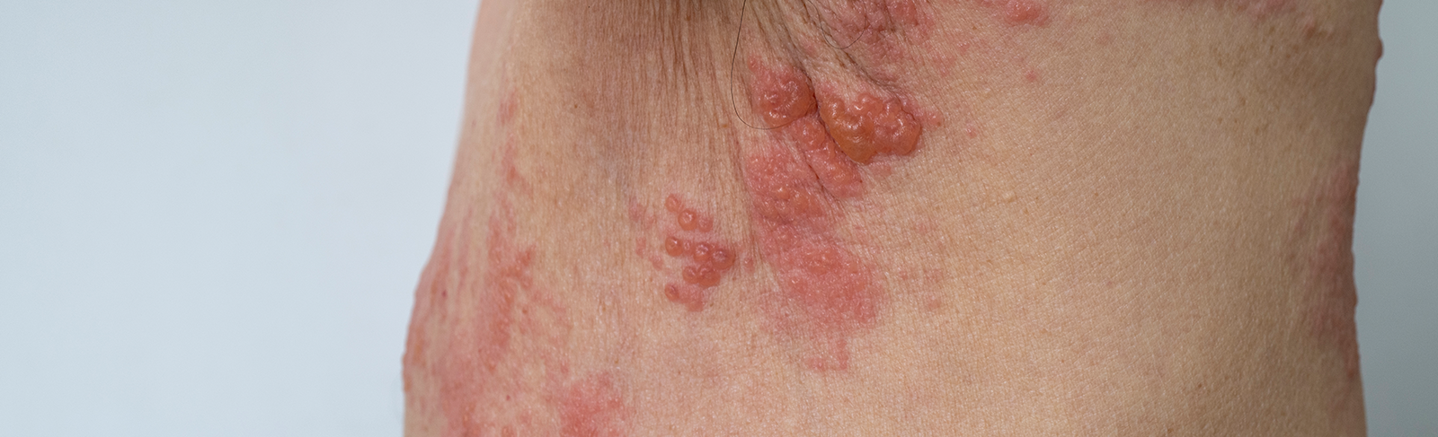 Shingles/rashes on a person.