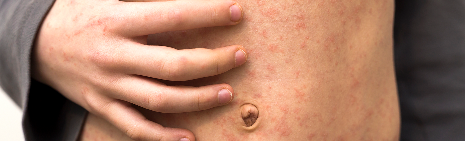 Measles on a person's stomach with their hand on their stomach.