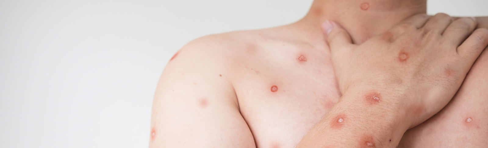 Image of a person's upper body with red spots