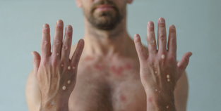 Image of monkeypox lesions and rash on someone's hands and chest