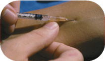 Injecting tubersol in a forearm