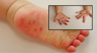 Close-up image of an infant's foot with rash. Overlapping image of infant hands with rash.