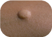 A forearm with an induration under skin