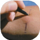 A head marking an induration on an arm